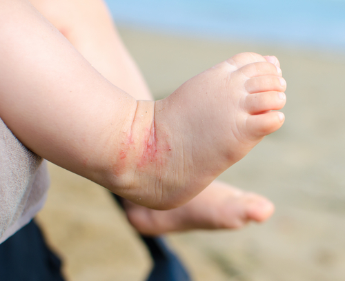 7 Myths About Eczema You Shouldn't Believe
