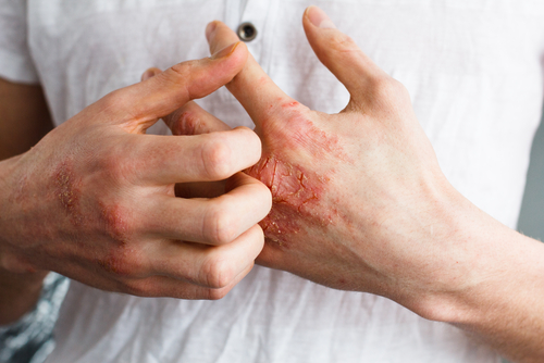 7 Myths About Eczema You Shouldn't Believe