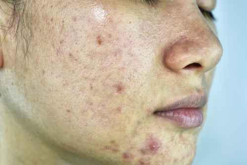 How Do I Stop Pimple Breakouts?