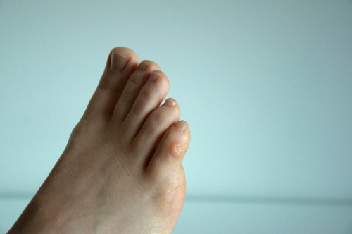 What Is The Cause Of Foot Corn and Calluses?