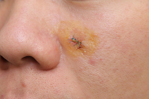Common Skin Conditions Requiring Surgical Dermatology